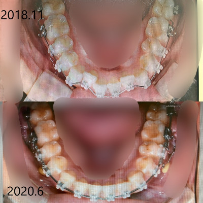 下の歯の矯正before・after画像